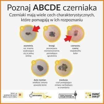 abcde czerniaka